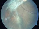 diabeticfibrosistrd_zeis06.jpg