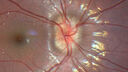disc-drusen_child_pahav_033023_02.jpg