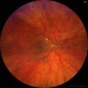 dme_htn-choroid_padod1_052523_01.jpg