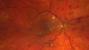 dme_htn-choroid_padod1_052523_02.jpg