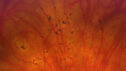dme_htn-choroid_padod1_052523_04.jpg