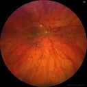 dme_htn-choroid_padod1_052523_05.jpg