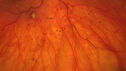 dme_htn-choroid_padod1_052523_06.jpg