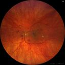 dme_htn-choroid_padod1_052523_07.jpg