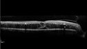 dme_htn-choroid_padod1_052523_12.jpg