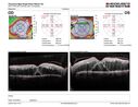 dme_htn-choroid_padod1_052523_16.JPG