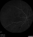 dme_htn-choroid_padod1_052523_18.jpg