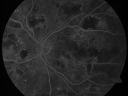 dmhypertensiveretin_61852sufr_281029.jpg