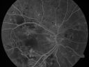dmhypertensiveretin_61852sufr_28729.jpg
