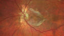 drusen-cnvm_dasou1_061322_02.jpg