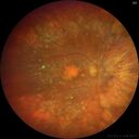 dryAMDGA-CRVO-edemaOS_bacom1_083020_01.jpg
