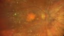 dryAMDGA-CRVO-edemaOS_bacom1_083020_02~0.jpg