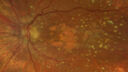 dryAMDGA-CRVO-edemaOS_bacom1_083020_04~0.jpg