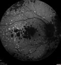 dryAMDGA-CRVO-edemaOS_bacom1_083020_05.jpg