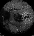 dryAMDGA-CRVO-edemaOS_bacom1_083020_06~0.jpg