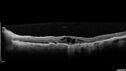 dryAMDGA-CRVO-edemaOS_bacom1_083020_10.jpg