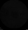 dryAMDGA-CRVO-edemaOS_bacom1_083020_16~0.jpg