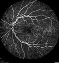 dryAMDGA-CRVO-edemaOS_bacom1_083020_20~0.jpg