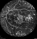 dryAMDGA-CRVO-edemaOS_bacom1_083020_24~0.jpg