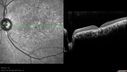 dystcone_chsa_082313_15.avi
