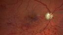 edema-RVO_brcol1_082222_01c.jpg