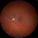 edema-RVO_brcol1_082222_02.jpg