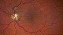 edema-RVO_brcol1_082222_02c.jpg