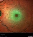 edema-RVO_brcol1_082222_04.jpg