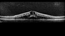 edema-RVO_brcol1_082222_10.jpg