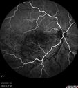 edema-RVO_brcol1_082222_14.jpg