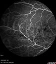 edema-RVO_brcol1_082222_19.jpg