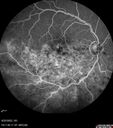edema-RVO_brcol1_082222_22.jpg