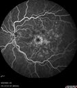 edema-RVO_brcol1_082222_24.jpg