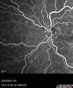 edema-RVO_brcol1_082222_26.jpg