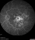 edema-RVO_brcol1_082222_27.jpg