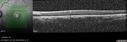 Filename=granuloma_sarcoid_USF-BR_29.jpg
Filesize=565KiB
Dimensions=1380x456
Date added=Feb 12, 2022 granuloma_sarcoid_USF-BR_29.jpg