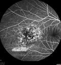 hemangioma_armar1_081721_08.jpg