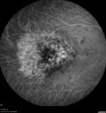 hemangioma_armar1_081721_16.jpg