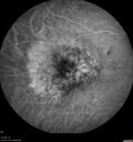 hemangioma_armar1_081721_17.jpg