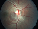 heme_outerretina_fero_032817_02.png
