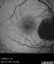 heme_outerretina_fero_032817_03.jpg