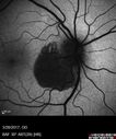 heme_outerretina_fero_032817_04.jpg