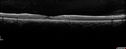 heme_outerretina_fero_032817_07.jpg