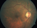 hemiCRVO_anbr_092716_01.png