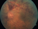hemiCRVO_anbr_092716_03.png