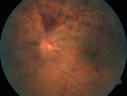 hemiCRVO_anbr_092716_04.png