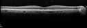 hemiCRVO_anbr_092716_06.jpg