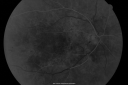 hypertensivechronic_jowe09.png