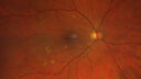 large-hyperref-drusen_mikat_051523_01.jpg