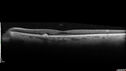 large-hyperref-drusen_mikat_051523_10.jpg